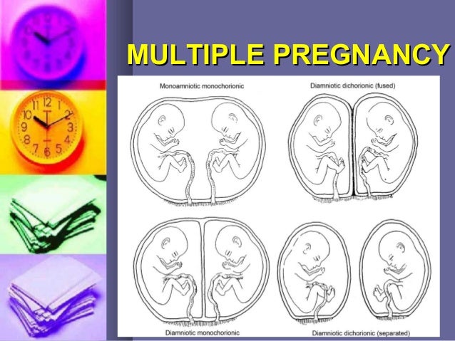 Sign of multiple pregnancy